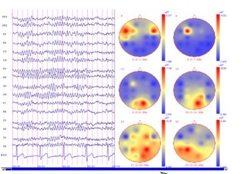 PC Based Portable EEG Machine