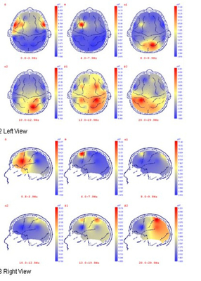 PC Based Portable EEG Machine
